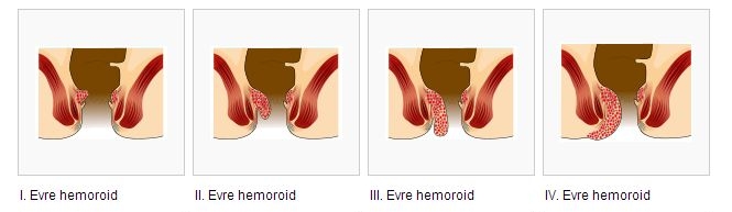 Hemoroid_basur_evreler