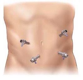 Laparoscopic-Repair-Trocars